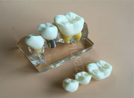 Foto van Schoonheid gezondheid clear dental demonstration study teeth model for implant analysis crown bridge