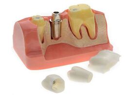 Foto van Schoonheid gezondheid professional teeth model transparent pathological implant nerve for science di
