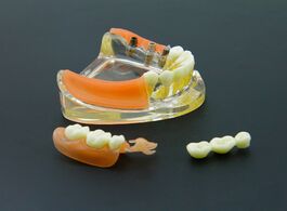 Foto van Schoonheid gezondheid dental implant restoration teeth model removable bridge denture demo 6006