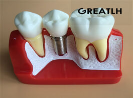 Foto van Schoonheid gezondheid dental implant analysis crown bridge demonstration model dentist tools study