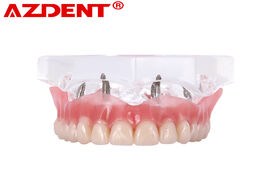 Foto van Schoonheid gezondheid dental overdenture teeth implant model demo restoration with implants upper