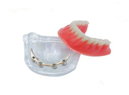 Foto van Schoonheid gezondheid overdenture implant model denture teeth mandibular with golden bar dental teac