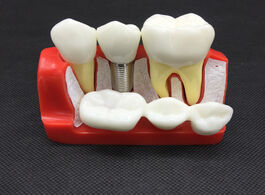 Foto van Schoonheid gezondheid 4 times dental implant analysis crown bridge demonstration teeth model dentist