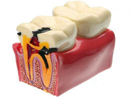 Foto van Schoonheid gezondheid 1 pc dental materials lab teeth model 6 times caries comparation study models 